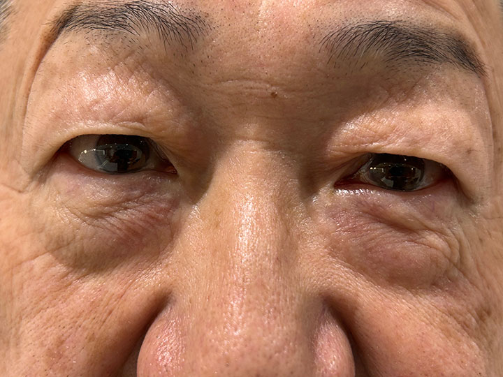 眼瞼下垂の治療薬「アップニーク点眼液」取り扱い開始しました